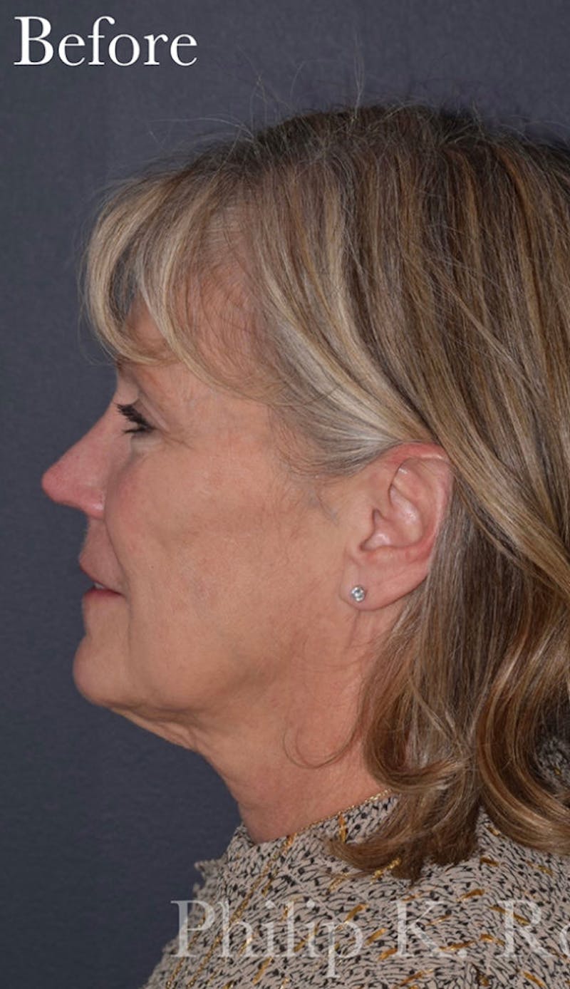 Cosmetic Non-Surgical Before & After Gallery - Patient 63360617 - Image 9