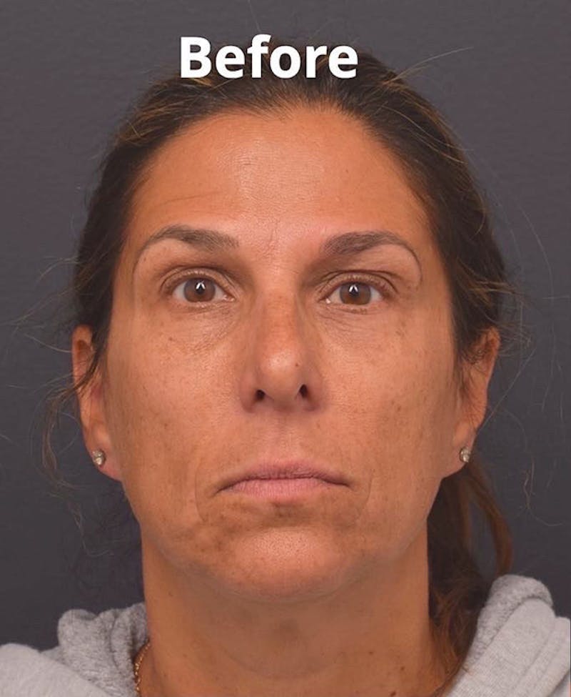 Face Before & After Gallery - Patient 63360619 - Image 1