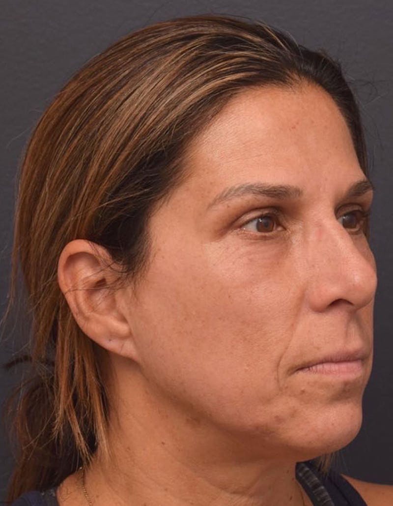 Face Before & After Gallery - Patient 63360619 - Image 4
