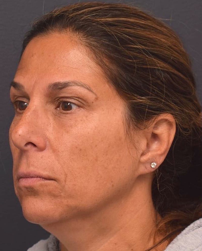Face Before & After Gallery - Patient 63360619 - Image 5