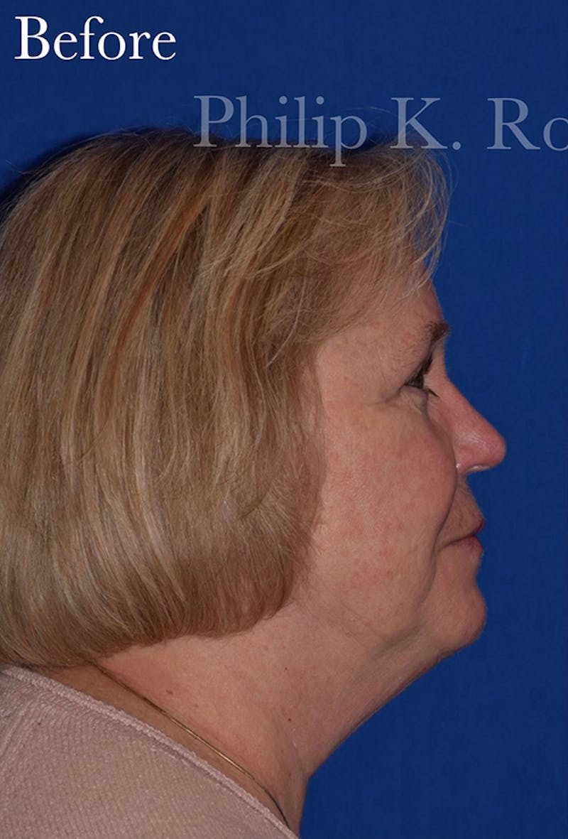 Non-Surgical Before & After Gallery - Patient 63360626 - Image 5