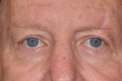 Face Before & After Gallery - Patient 63360625 - Image 2