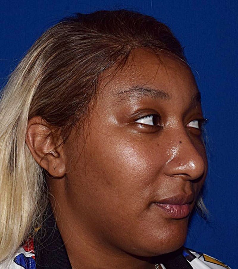 Face Before & After Gallery - Patient 63360627 - Image 3