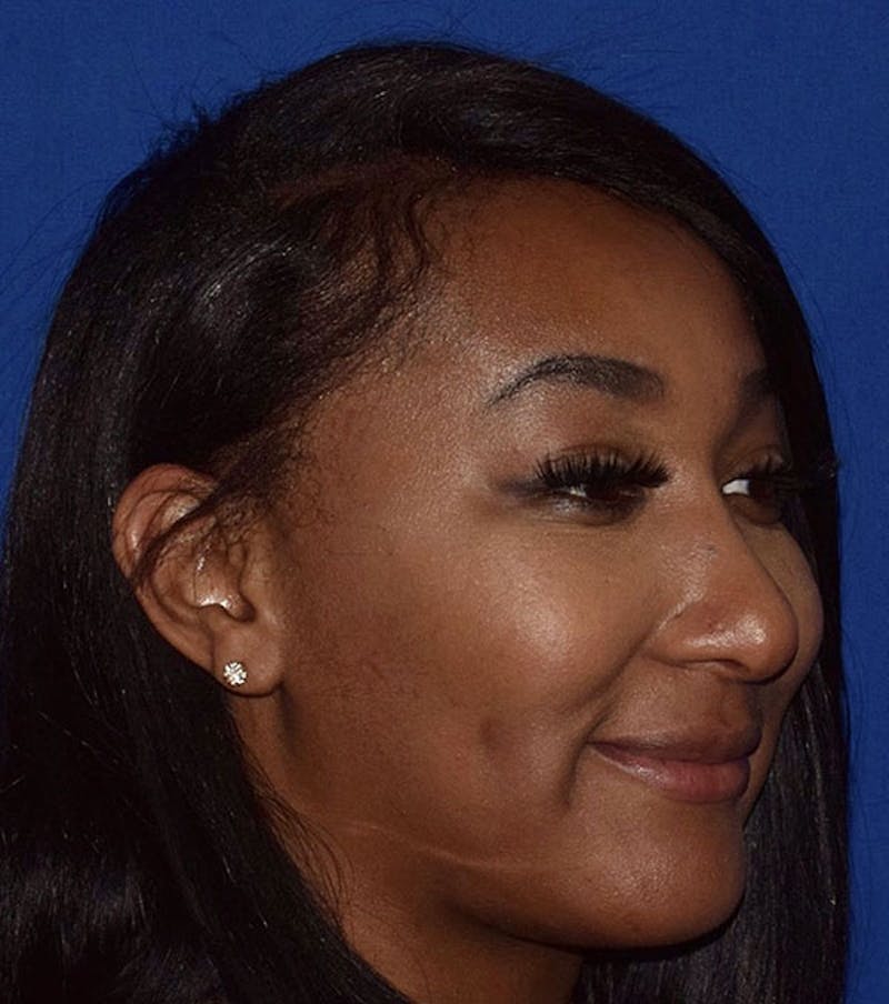 Face Before & After Gallery - Patient 63360627 - Image 4