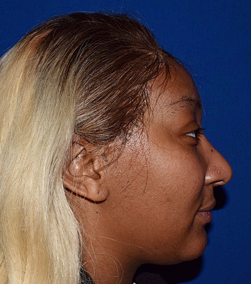 Face Before & After Gallery - Patient 63360627 - Image 5