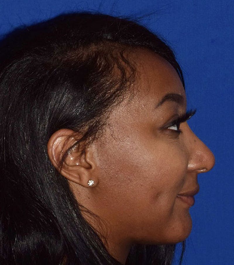 Face Before & After Gallery - Patient 63360627 - Image 6