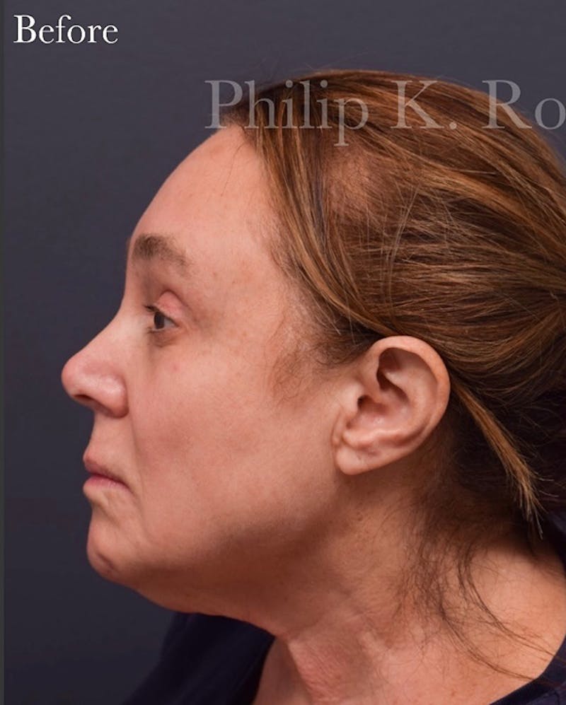 Cosmetic Non-Surgical Before & After Gallery - Patient 63360628 - Image 3