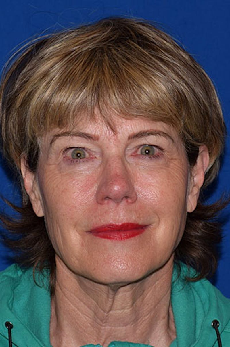 Face Before & After Gallery - Patient 63360633 - Image 1
