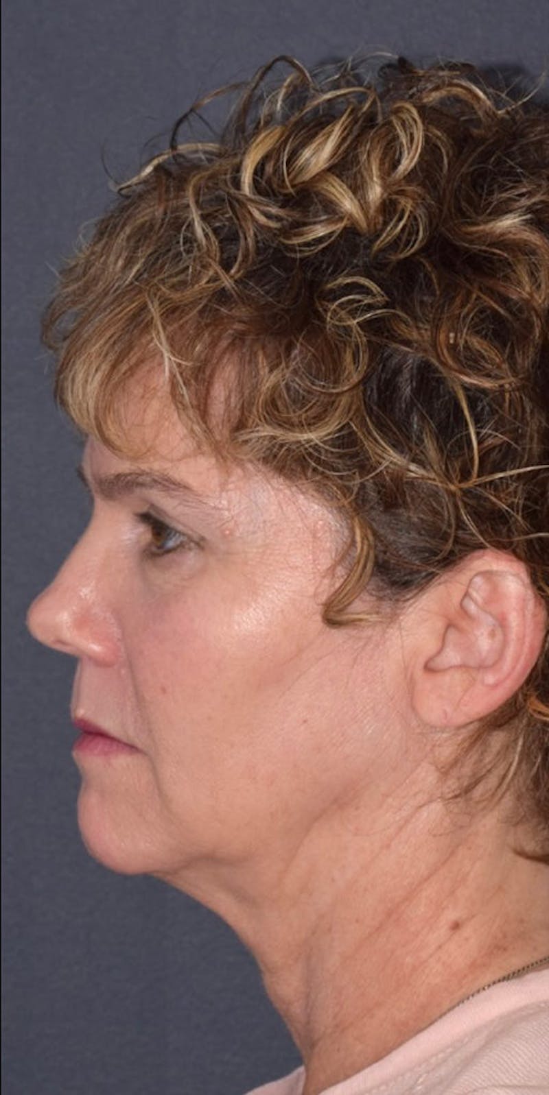Non-Surgical Before & After Gallery - Patient 63360632 - Image 5