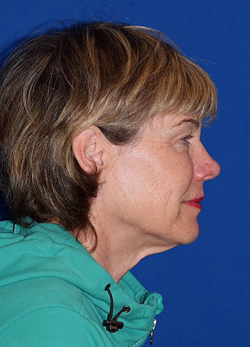 Face Before & After Gallery - Patient 63360633 - Image 3