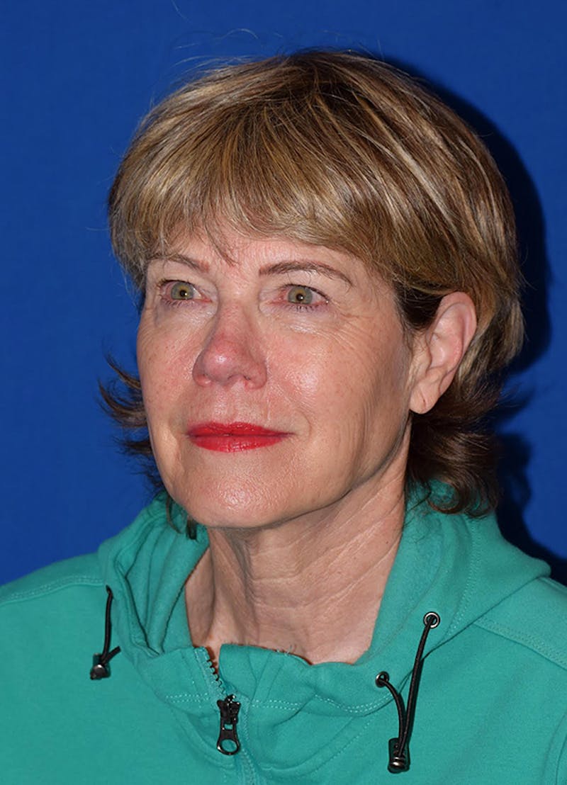 Face Before & After Gallery - Patient 63360633 - Image 5