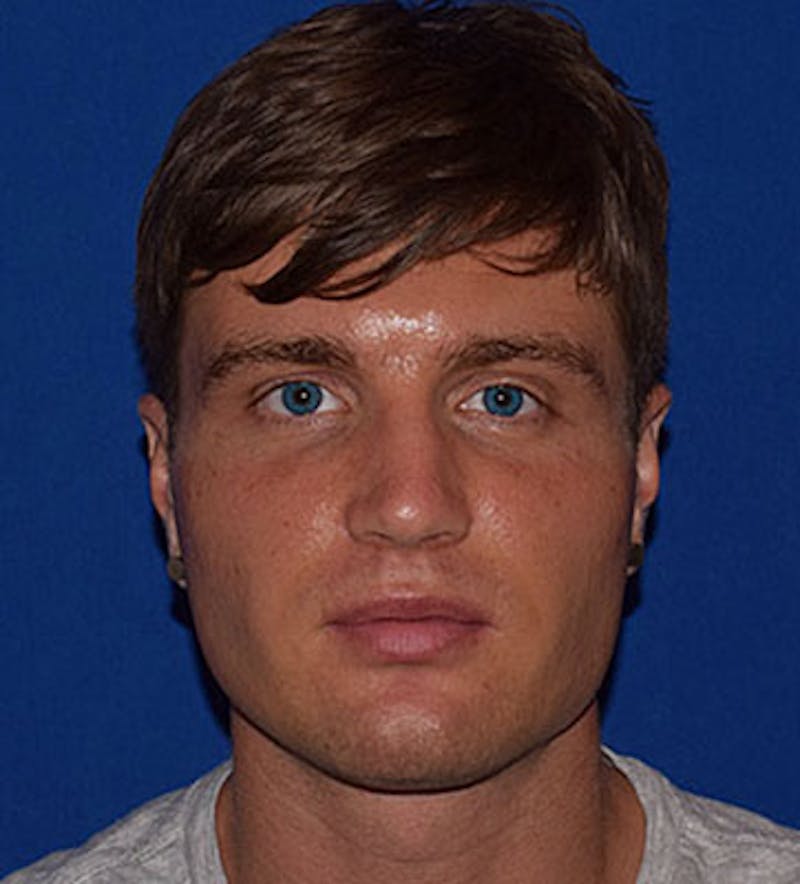 Face Before & After Gallery - Patient 63360636 - Image 1