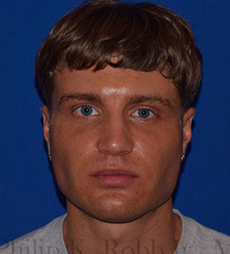 Face Before & After Gallery - Patient 63360636 - Image 2