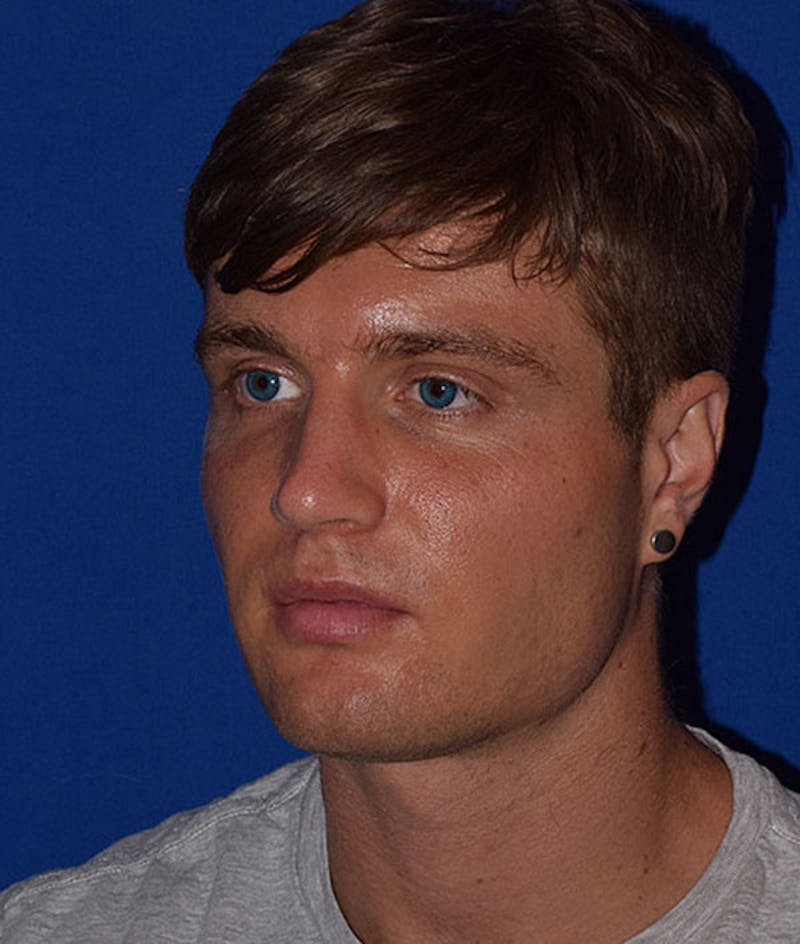 Face Before & After Gallery - Patient 63360636 - Image 3