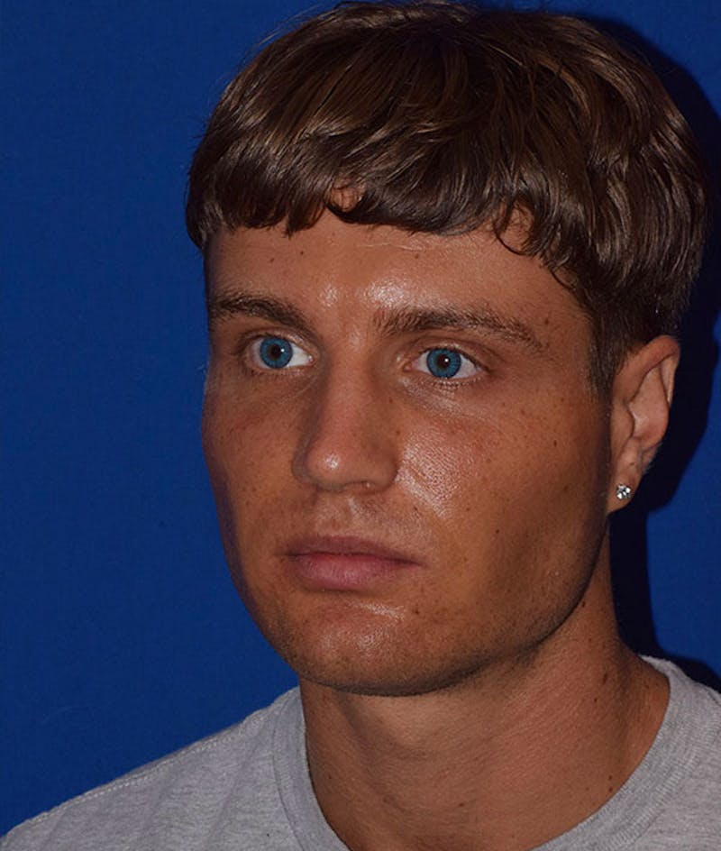 Face Before & After Gallery - Patient 63360636 - Image 4