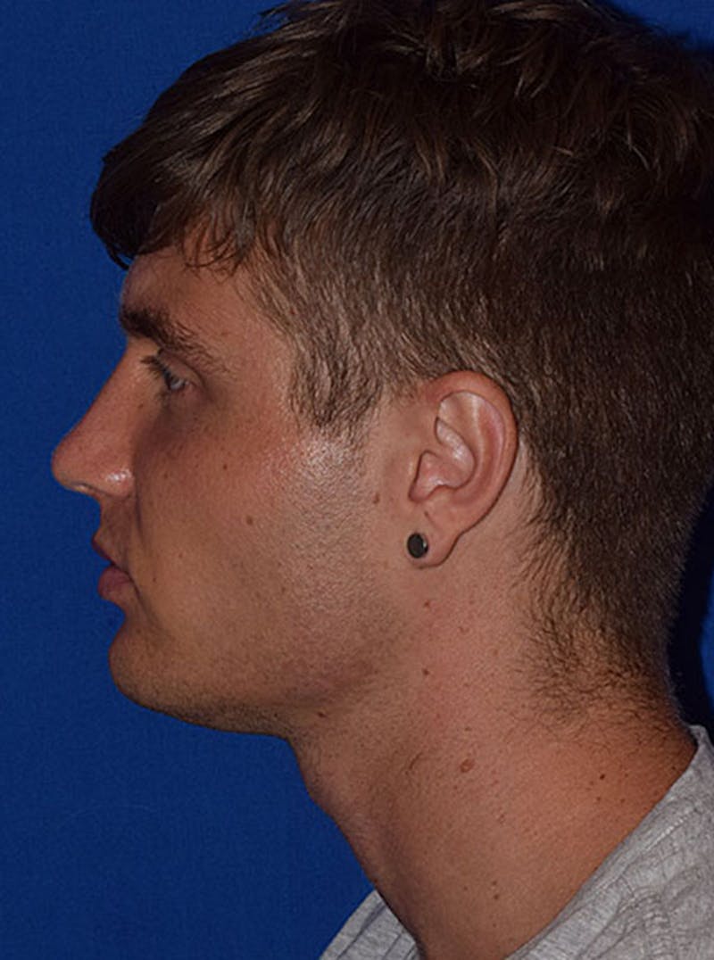 Face Before & After Gallery - Patient 63360636 - Image 5