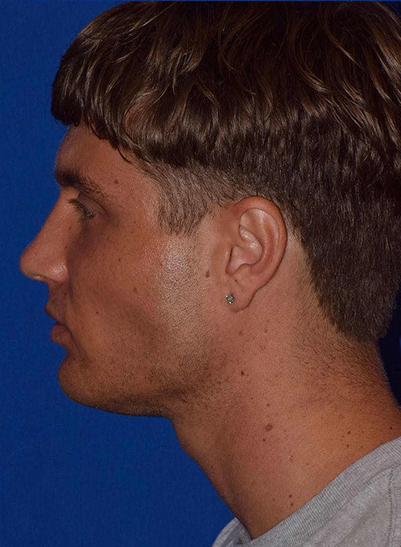 Face Before & After Gallery - Patient 63360636 - Image 6