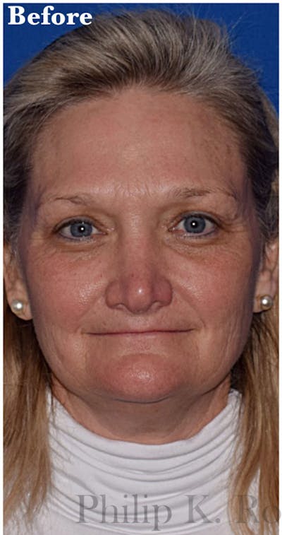 Cosmetic Surgical Before & After Gallery - Patient 63360748 - Image 1