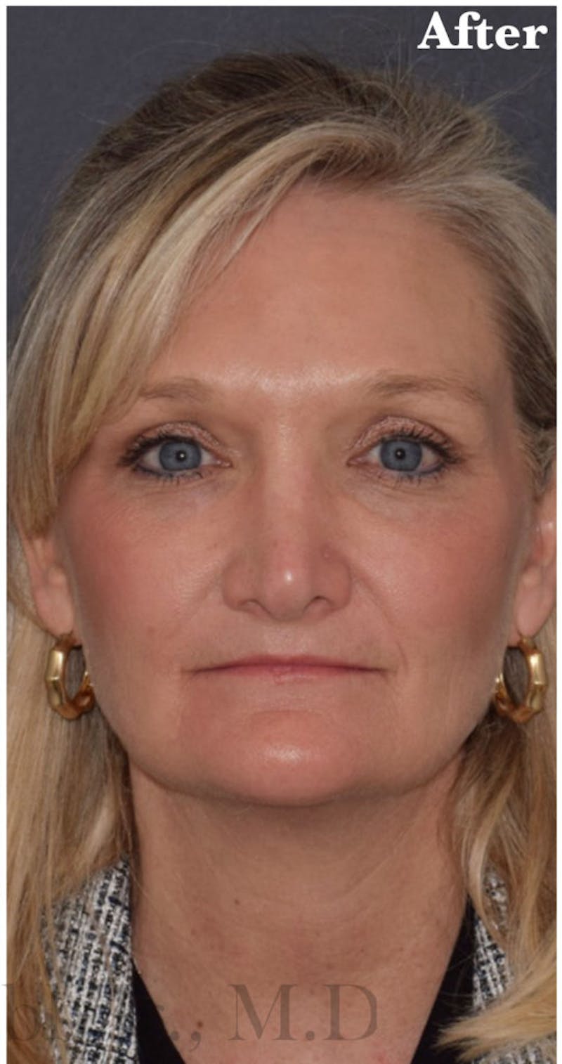 Face Before & After Gallery - Patient 63360748 - Image 2
