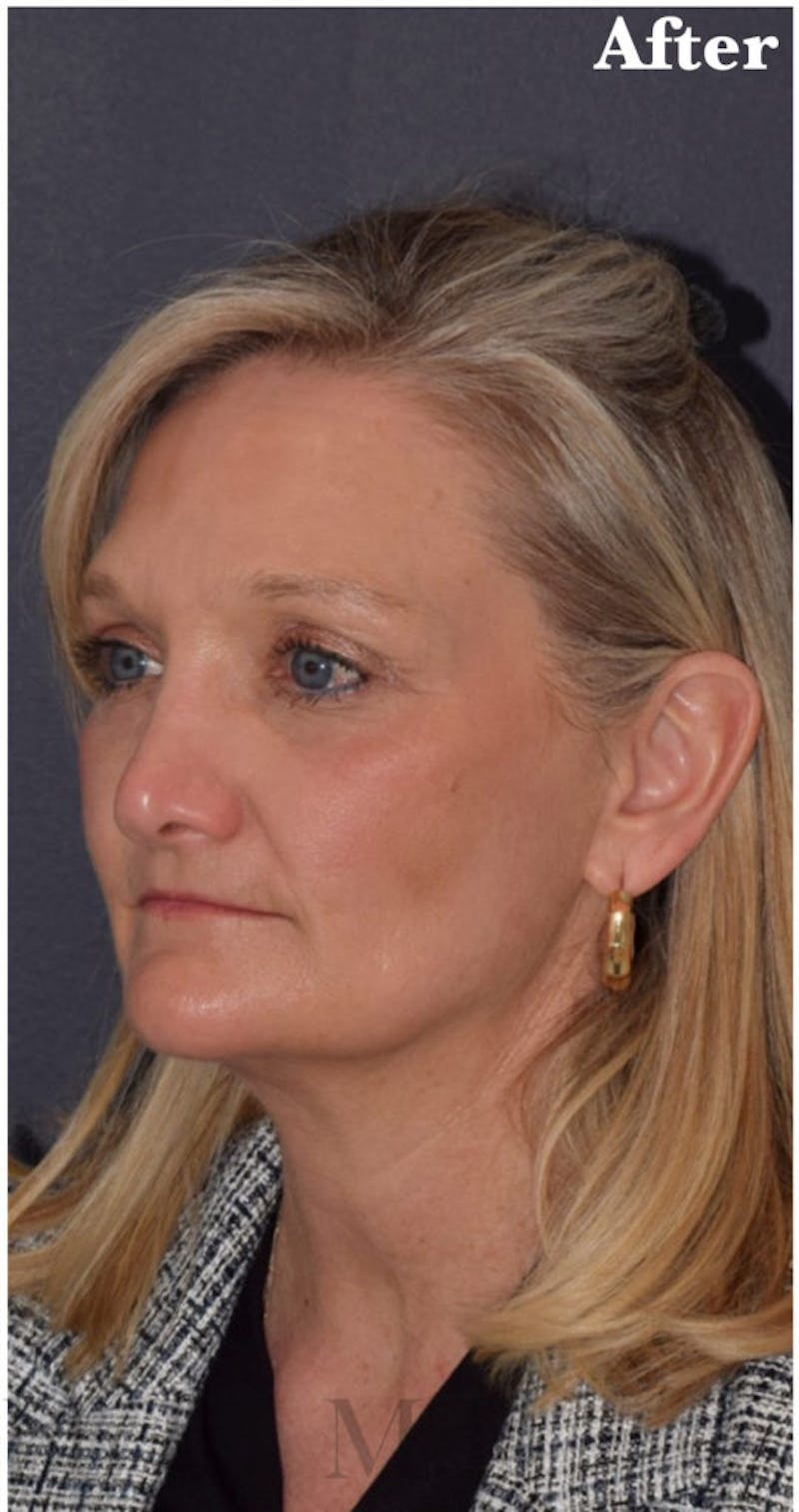 Face Before & After Gallery - Patient 63360748 - Image 4