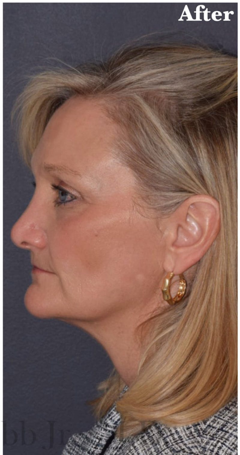 Face Before & After Gallery - Patient 63360748 - Image 6