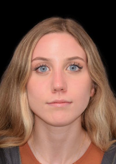 Cosmetic Surgical Before & After Gallery - Patient 63360752 - Image 2