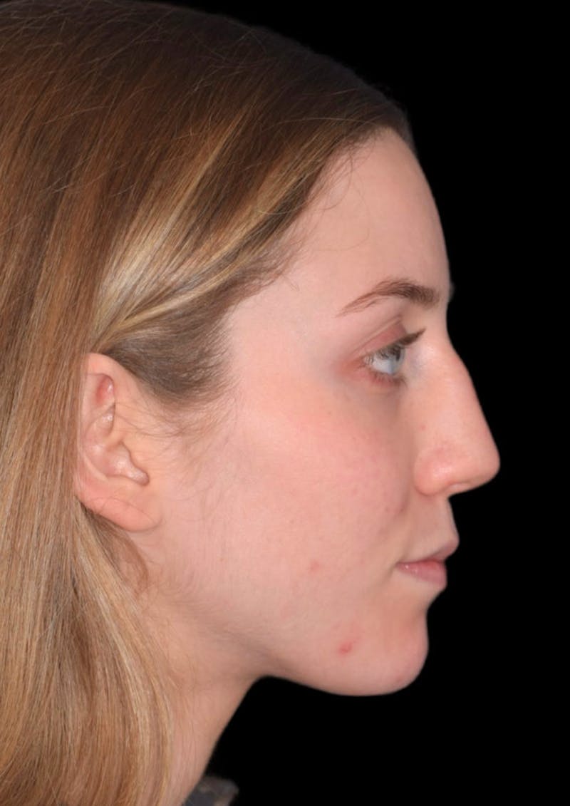 rhinoplasty procedure