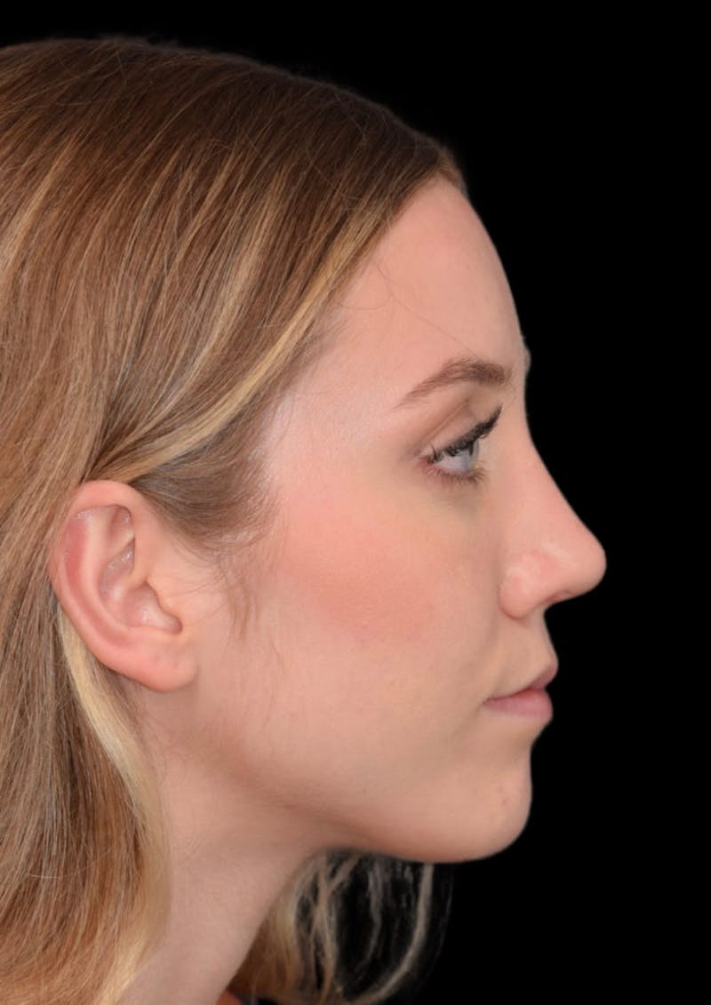 rhinoplasty procedure
