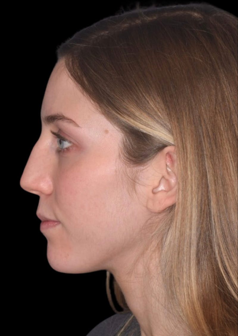Cosmetic Surgical Before & After Gallery - Patient 63360752 - Image 9