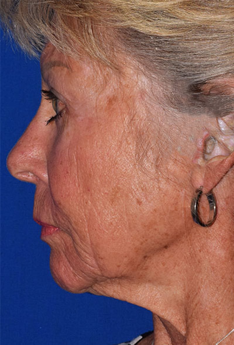 Cosmetic Non-Surgical Before & After Gallery - Patient 63360756 - Image 3