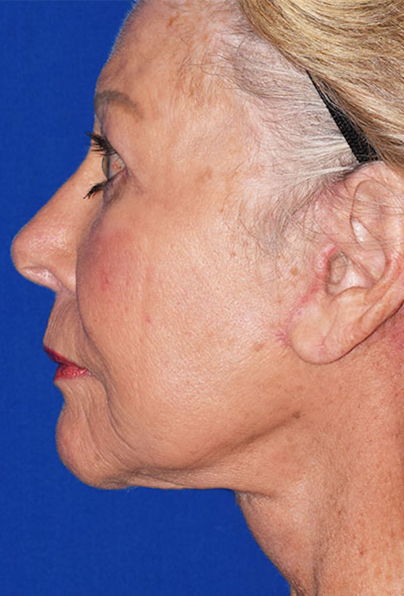 Non-Surgical Before & After Gallery - Patient 63360756 - Image 4