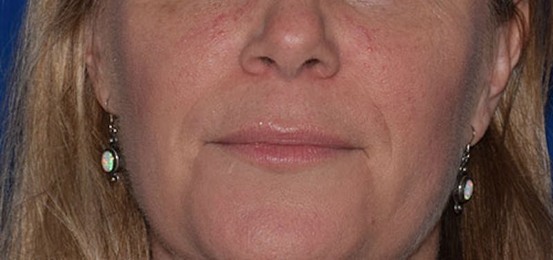 Face Before & After Gallery - Patient 63360758 - Image 1