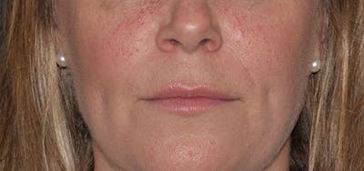 Cosmetic Surgical Before & After Gallery - Patient 63360758 - Image 2