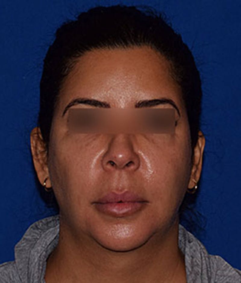 Face Before & After Gallery - Patient 63360763 - Image 1