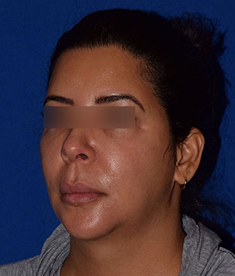 Face Before & After Gallery - Patient 63360763 - Image 3