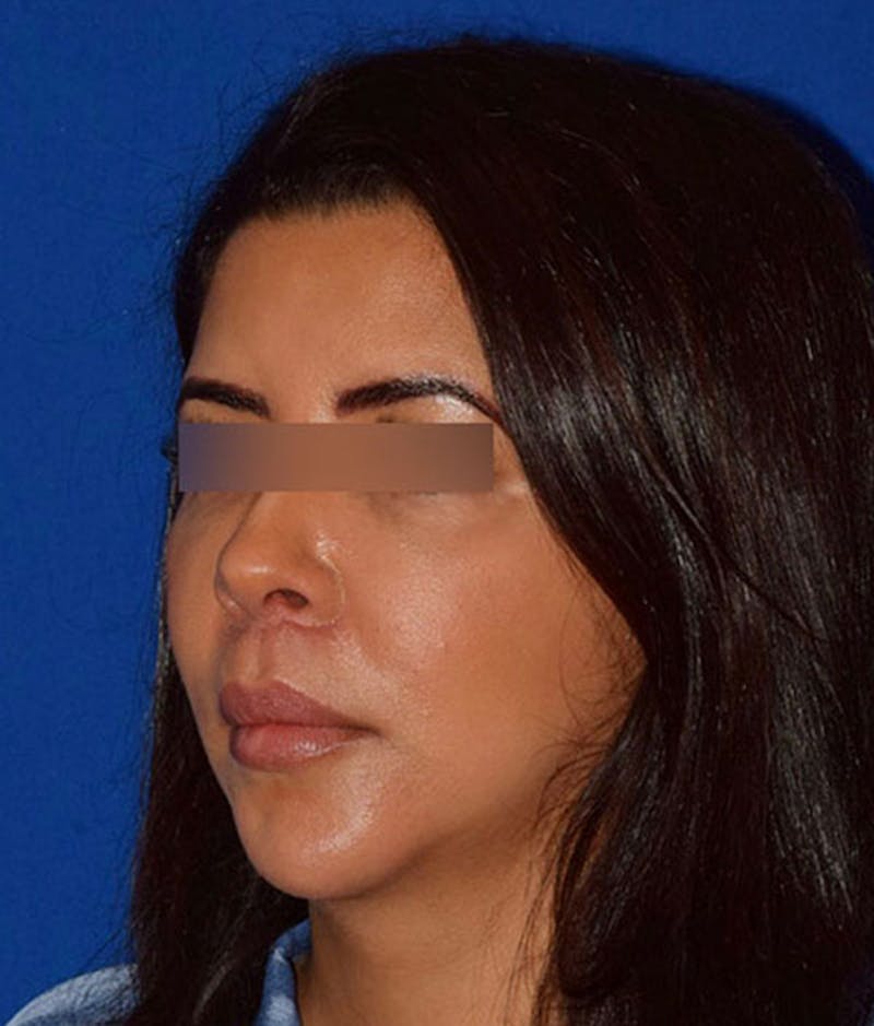 Face Before & After Gallery - Patient 63360763 - Image 4