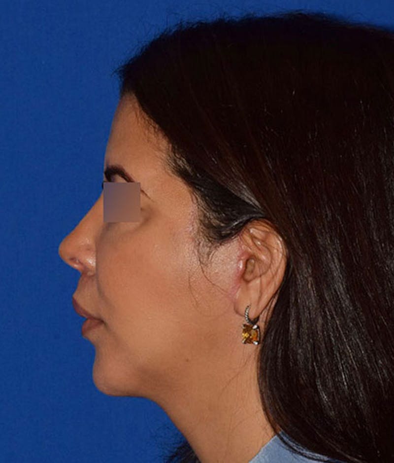 Face Before & After Gallery - Patient 63360763 - Image 6