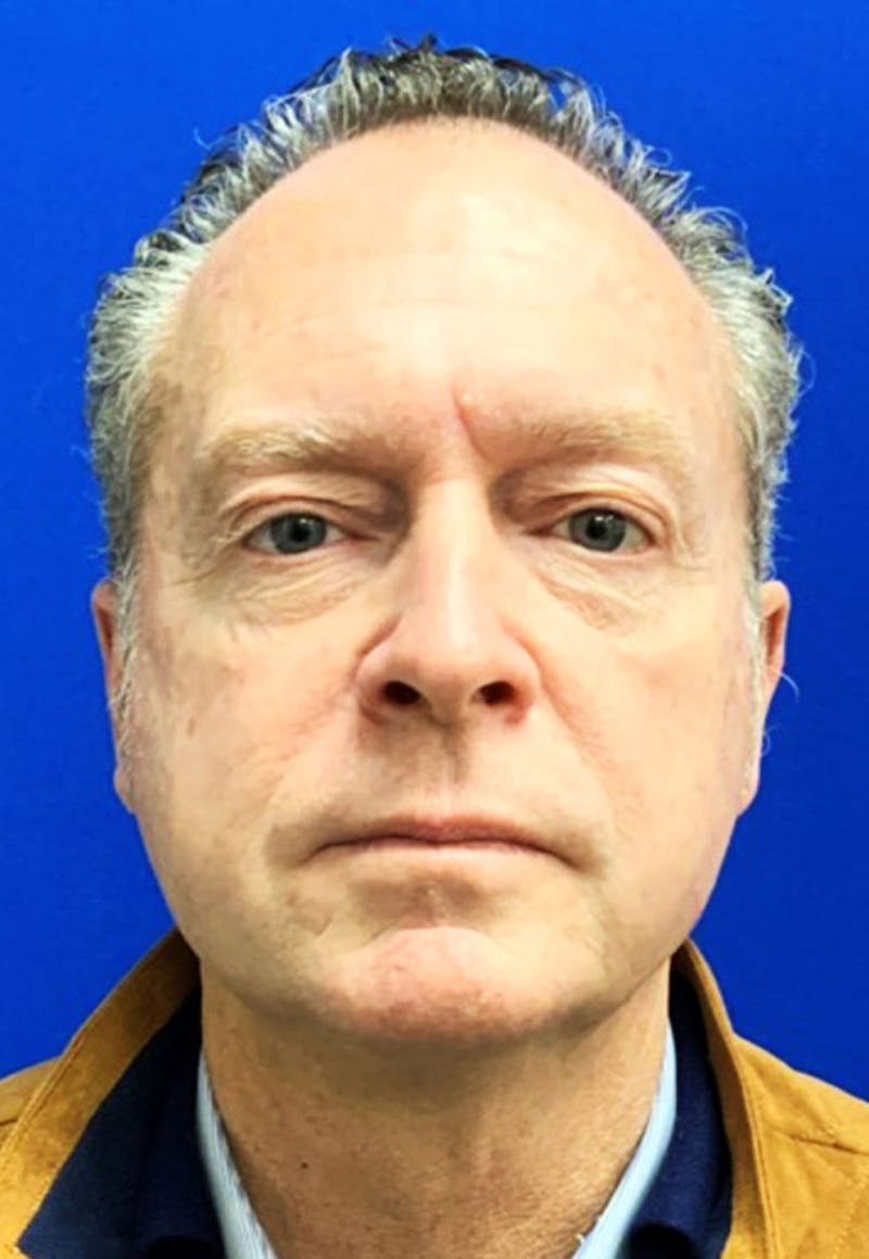 Face Before & After Gallery - Patient 63360766 - Image 1