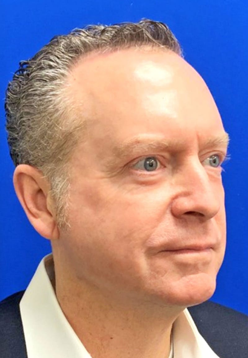 Face Before & After Gallery - Patient 63360766 - Image 4