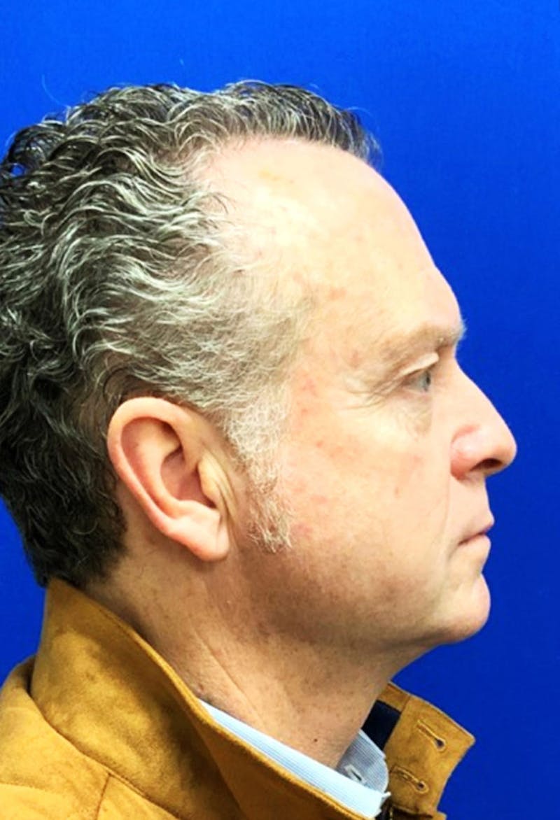Face Before & After Gallery - Patient 63360766 - Image 5