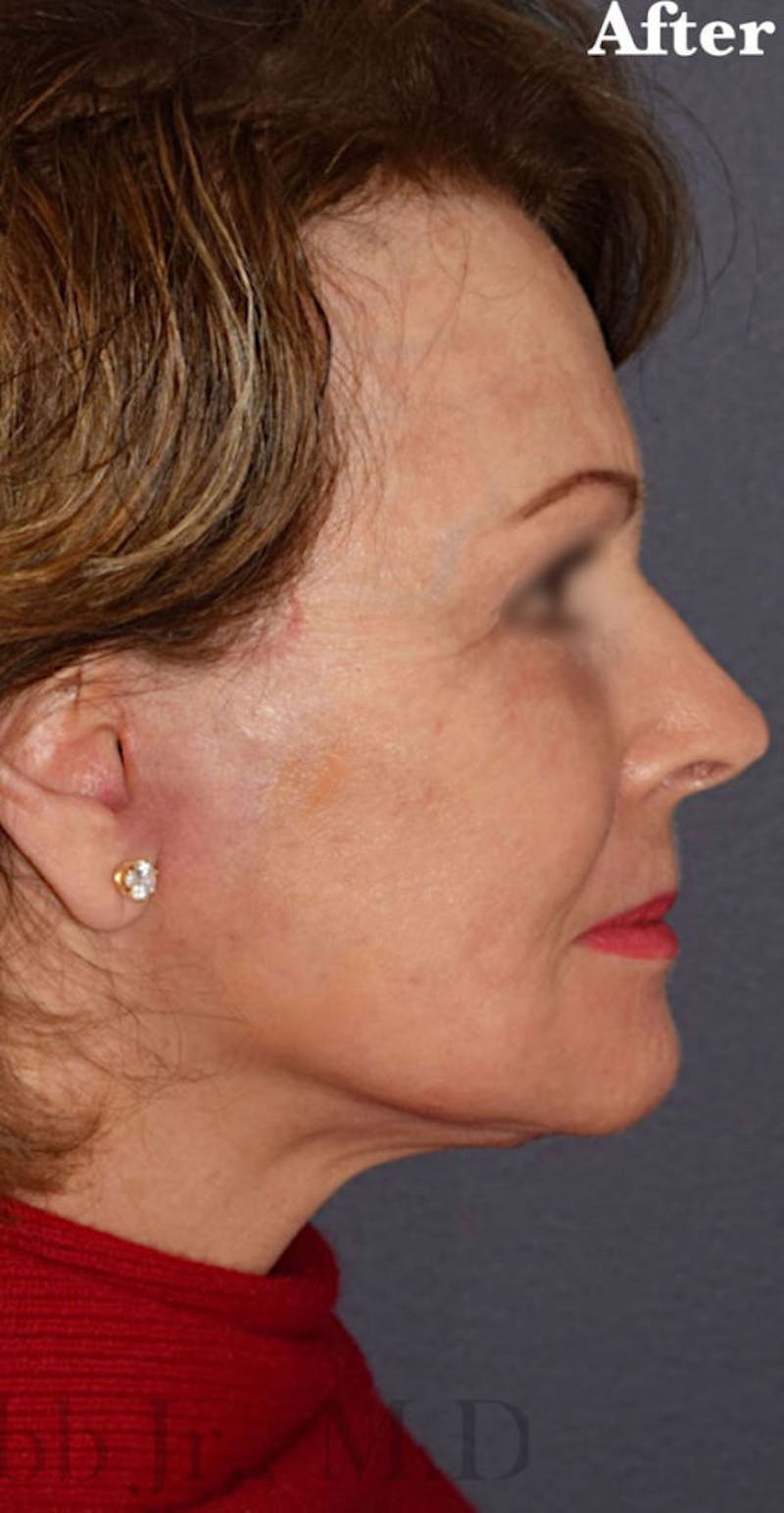 Cosmetic Non-Surgical Before & After Gallery - Patient 63360767 - Image 4