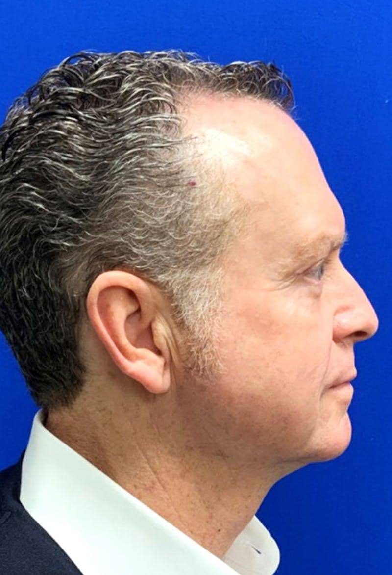 Face Before & After Gallery - Patient 63360766 - Image 6