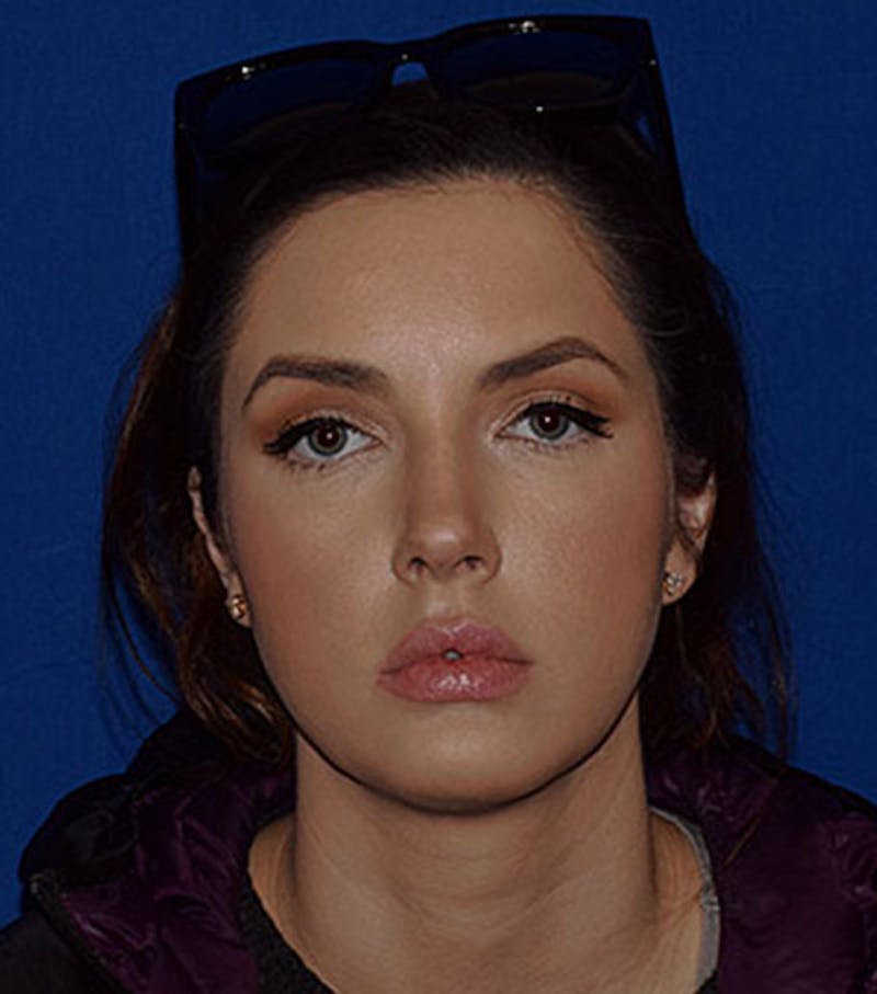 Face Before & After Gallery - Patient 63360768 - Image 1