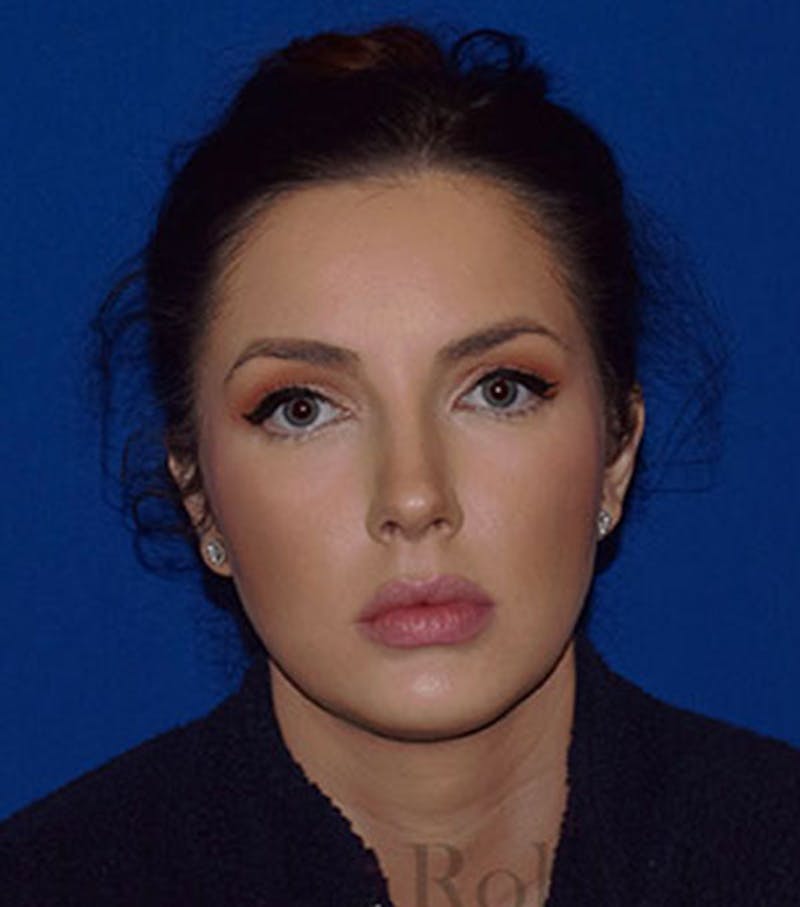 Face Before & After Gallery - Patient 63360768 - Image 2