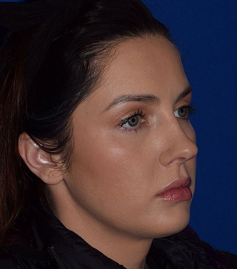 Face Before & After Gallery - Patient 63360768 - Image 3