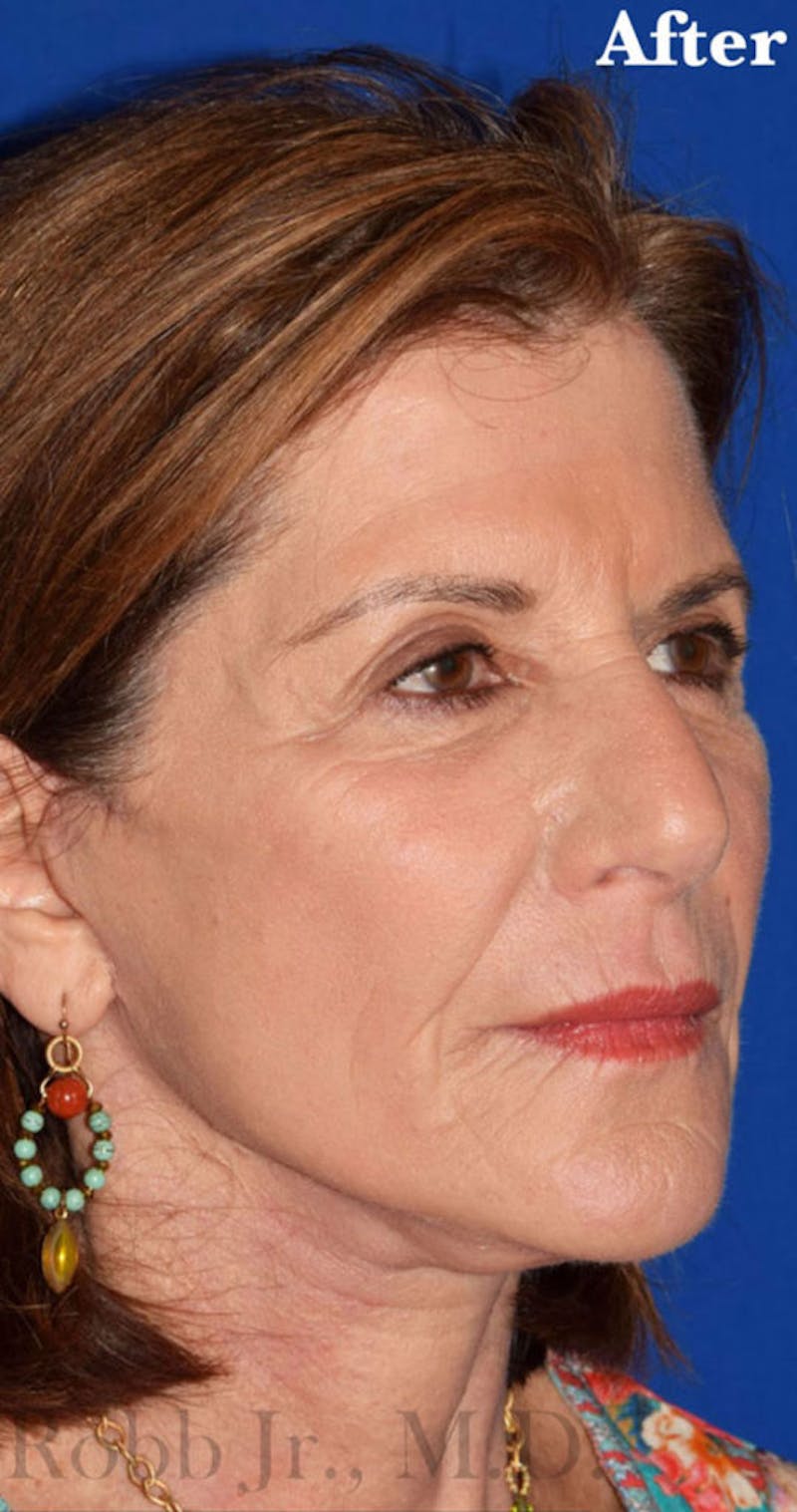Non-Surgical Before & After Gallery - Patient 63360770 - Image 4