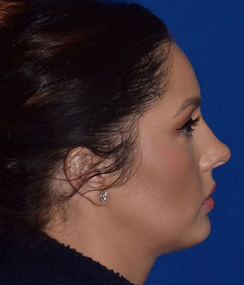 Face Before & After Gallery - Patient 63360768 - Image 6