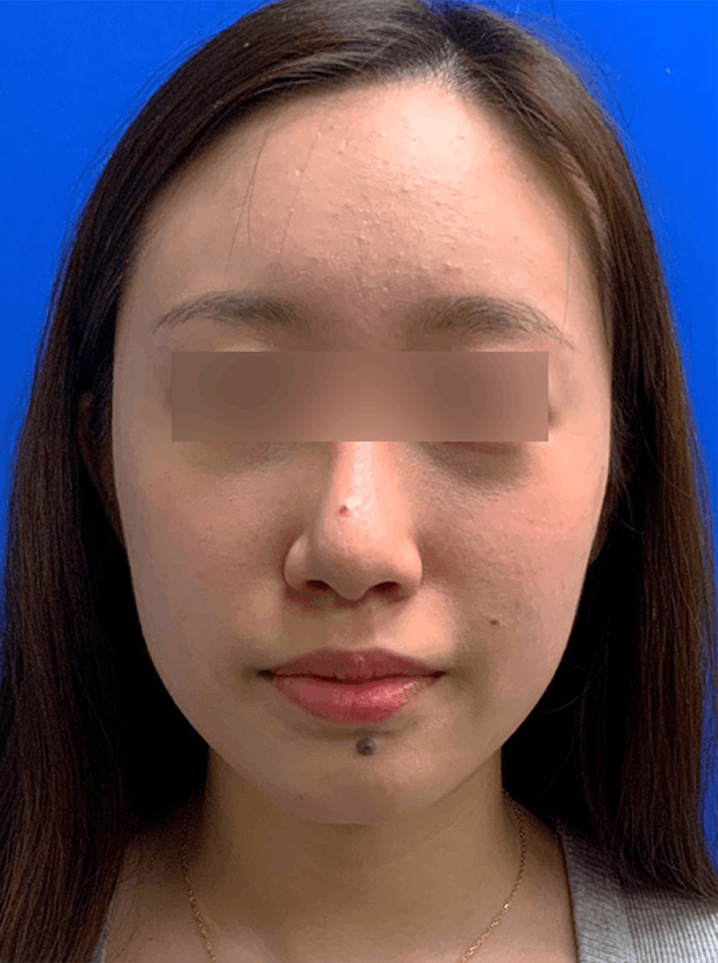 Face Before & After Gallery - Patient 63360771 - Image 1
