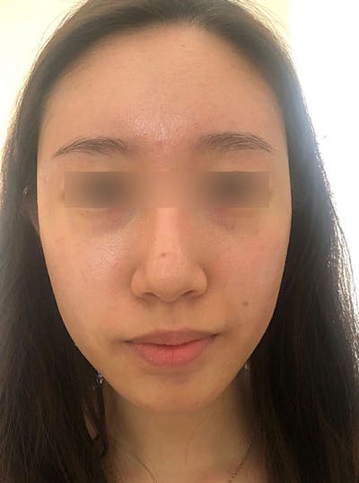 Face Before & After Gallery - Patient 63360771 - Image 2
