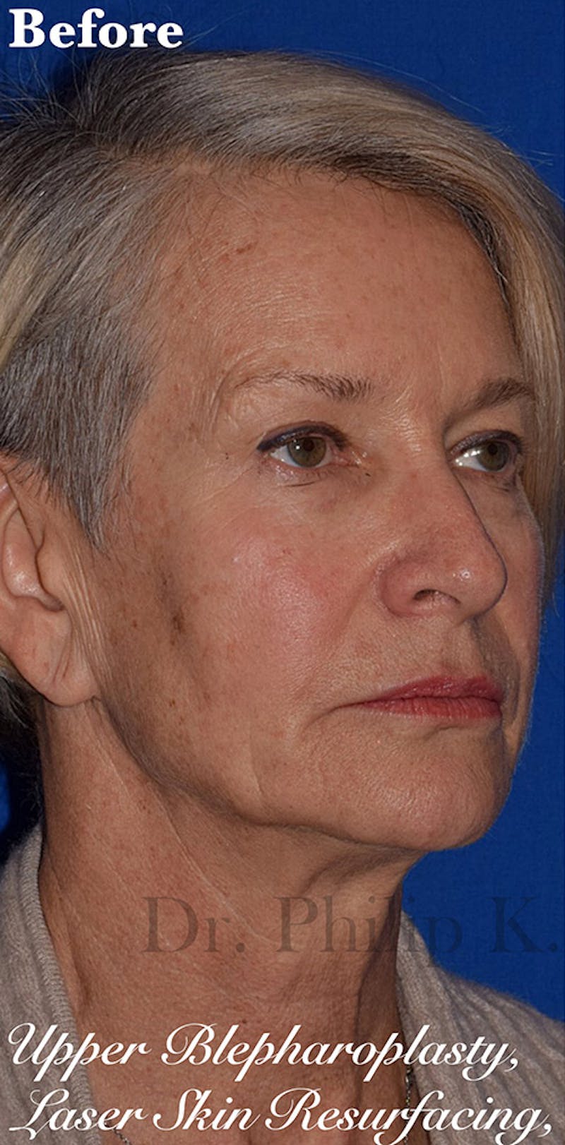 Face Before & After Gallery - Patient 63360773 - Image 3